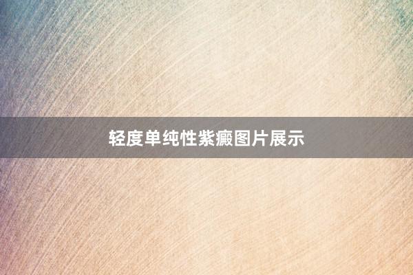 轻度单纯性紫癜图片展示